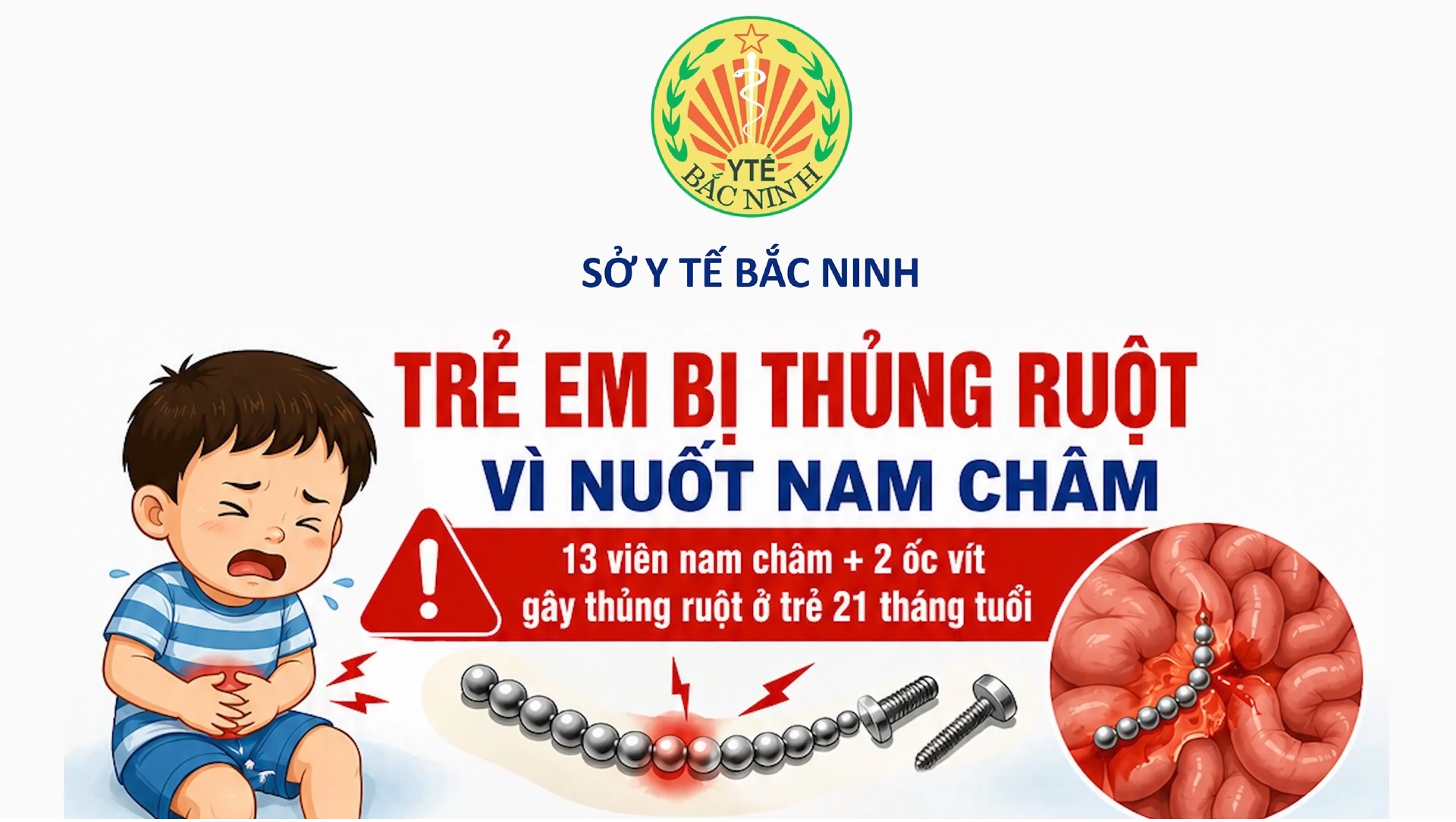 Bé 21 tháng tuổi bị thủng ruột vì nuốt nam châm